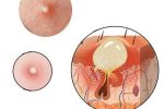 Nổi mụn đầu trắng ở vùng kín nữ giới là bệnh gì? Cách chữa trị