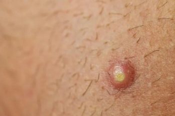 Các loại mụn dương vật: Nguyên nhân và phương pháp hiệu quả