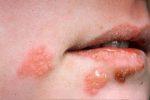 Tác hại của bệnh lậu là gì? Hiểm họa tiềm ẩn đe dọa sức khỏe sinh sản và tính mạng