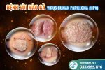 Mách bạn 5 dấu hiệu sùi mào gà điển hình, dễ nhận biết nhất