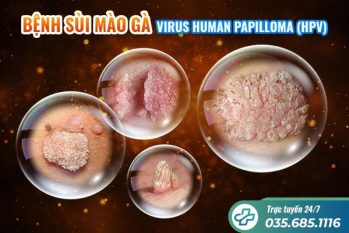 Mách bạn 5 dấu hiệu sùi mào gà điển hình, dễ nhận biết nhất