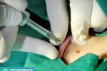 Phương pháp đốt sùi mào gà hiệu quả hay không?
