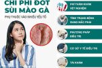 Chi phí đốt sùi mào gà bao nhiêu tiền – Bảng giá chi tiết tại Phòng khám Bệnh Xã hội HCM