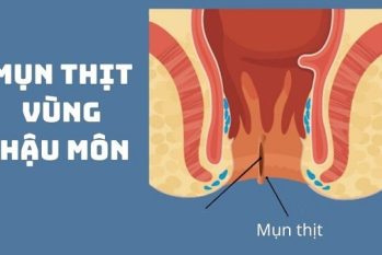 Mụn thịt hậu môn: Cảnh báo nguy hiểm từ dấu hiệu nhỏ nhặt đến mầm mống ung thư