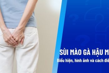 Sùi mào gà hậu môn – 10+ Thông tin quan trọng bạn cần nắm rõ
