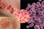[Cảnh Báo] 5 Nguyên nhân gây bệnh lậu – Tuyệt đối không được chủ quan