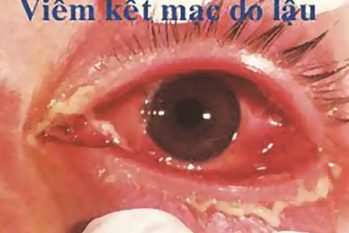 Hình ảnh bệnh lậu ở bộ phận sinh dục, miệng, mắt, hậu môn – Xem để nhận biết ngay