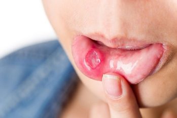 Cách nhận biết bệnh lậu: Những dấu hiệu điển hình không nên bỏ qua