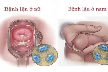Cảnh giác với triệu chứng bệnh lậu – Dễ nhầm, khó phát hiện, hậu quả khôn lường