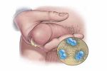 Dương vật bị lậu – Cảnh báo bệnh lý nguy hiểm nam giới không nên xem nhẹ