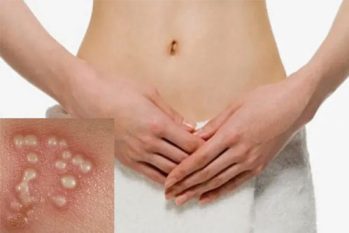 Mụn rộp sinh dục nữ: Dấu hiệu cảnh báo mà chị em không thể bỏ qua