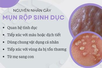 Nguyên nhân gây mụn rộp sinh dục và cách phòng tránh hiệu quả