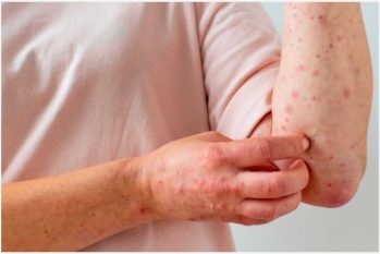 Cách chữa bệnh giang mai hiệu quả, giảm khả năng tái phát