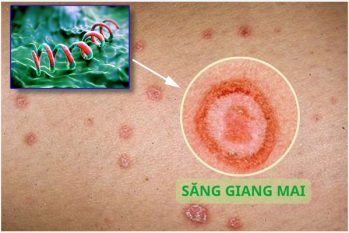 Bệnh giang mai là gì? Phải làm gì khi bị nhiễm bệnh?