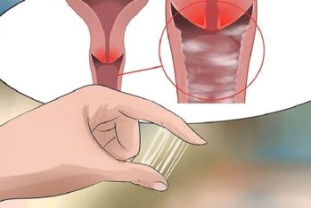Âm đạo chảy mủ là biểu hiện của bệnh gì? Có nguy hiểm không?