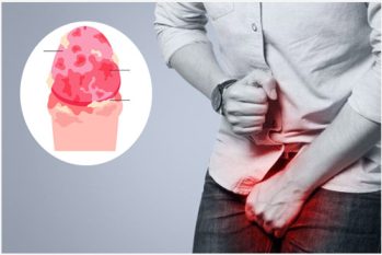 Dương vật bị loét có sao không? Cách khắc phục hiệu quả?