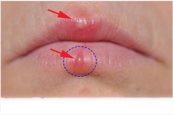 Miệng bị nổi mụn nước là bị gì? Cách chữa trị nhanh và hiệu quả?