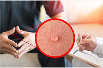 Mụn cóc sinh dục ở nam giới: Dấu hiệu, Hình ảnh và Cách khắc phục hiệu quả