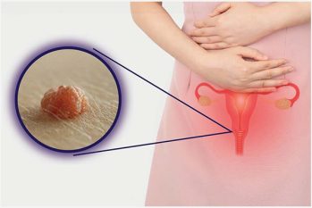 Nhận biết mụn cóc sinh dục ở nữ giới thông qua hình ảnh và triệu chứng