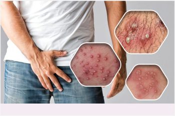 Nổi mụn mủ vùng kín: Nguyên nhân, triệu chứng và cách điều trị