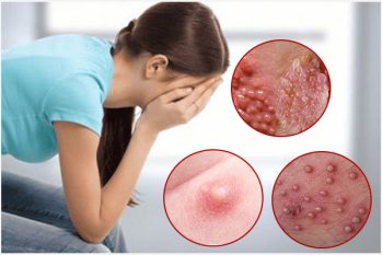 Nổi mụn môi lớn, môi bé âm đạo coi chừng mắc bệnh xã hội