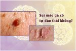 Sùi mào gà tự đào thải sau một thời gian có đúng không? Sự thật bạn nên biết rõ