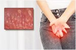 U nhú sinh dục là gì? Bệnh có nguy hiểm không?