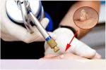 Xịt nitơ lỏng sùi mào gà có tốt không? Địa chỉ khám chữa sùi mào gà uy tín, hiệu quả